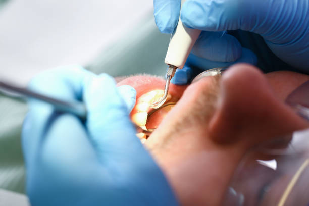 Best Emergency Dental Care for Abscessed Tooth in Salem, VA