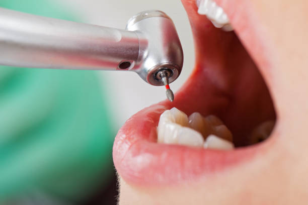 Best Emergency Root Canal Treatment in Salem, VA